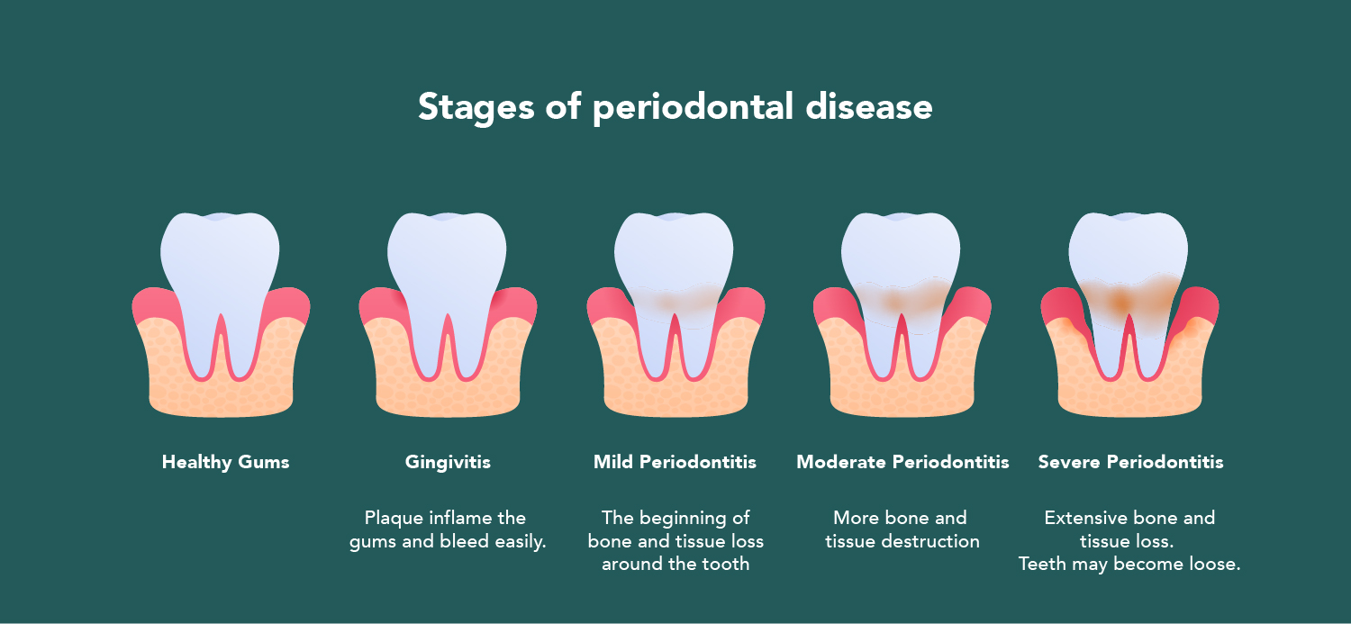 Treatment of Gum Disease | Prairie Periodontics