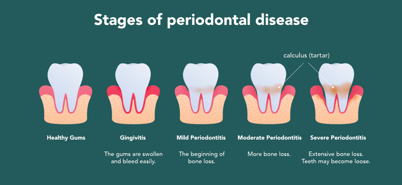 Treatment of Gum Disease | Prairie Periodontics